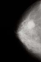 mammogram